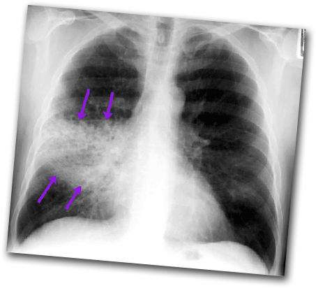 Respiratory-pneumonia-one